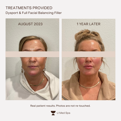 Treatment Results - Every appointment at U Med Spa begins with a full facial consultation by our licensed and trained service providers. Our practitioners tailor each treatment based on the customer’s skin type, texture, and skincare concerns. Type of product and the total amount that each customer needs will vary and will be determined based on the consultation. All of our providers are licensed with multiple years of experience in their specialty. Treatment Results - Every appointment at U Med Spa begins with a full facial consultation by our licensed and trained service providers. Our practitioners tailor each treatment based on the customer’s skin type, texture, and skincare concerns. Type of product and the total amount that each customer needs will vary and will be determined based on the consultation. All of our providers are licensed with multiple years of experience in their specialty.