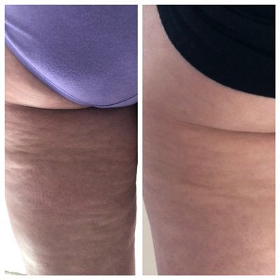 Cellulite and circumferential reduction using Radiofrequency - Cellulite treatment , circumferential reduction and skin tightening using Radiofrequency. Cellulite and circumferential reduction using Radiofrequency - Cellulite treatment , circumferential reduction and skin tightening using Radiofrequency.