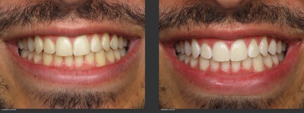 Teeth Whitening - Our offices uses the Zoom Teeth Whitening system as its the best. Sometimes your natural smile just needs a boost. The process takes 1 Hour to complete, painless and highly effective to get your teeth as white as they can get. Call today for details. Teeth Whitening - Our offices uses the Zoom Teeth Whitening system as its the best. Sometimes your natural smile just needs a boost. The process takes 1 Hour to complete, painless and highly effective to get your teeth as white as they can get. Call today for details.
