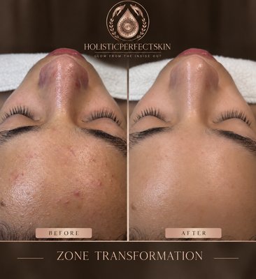 T-Zone Clarifying Facial - Purifying facial focused on deep cleansing the T-zone, reducing visible congestion, refining skin texture, and leaving the complexion looking clearer, smoother, and refreshed. T-Zone Clarifying Facial - Purifying facial focused on deep cleansing the T-zone, reducing visible congestion, refining skin texture, and leaving the complexion looking clearer, smoother, and refreshed.