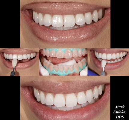 Teeth Whitening - Before and after photos of teeth whitening performed by Dr. Mark Kuioka. Teeth Whitening - Before and after photos of teeth whitening performed by Dr. Mark Kuioka.