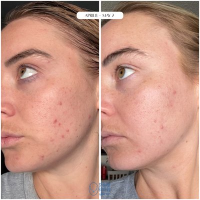 Face Reality Regimen - This client entrusted me with her skincare journey, and after just three weeks of using her tailored Face Reality products, she is already glowing and happy with her progress! We started targeting her inflammation, and now we can focus on addressing her other concerns.
Ditch the over-the-counter options and TikTok trends, and let me formulate the perfect skincare cocktail just for YOU!
Medical-grade skincare not only prevents issues but also correct them, making it a worthwhile investment for your skin’s health and beauty. Face Reality Regimen - This client entrusted me with her skincare journey, and after just three weeks of using her tailored Face Reality products, she is already glowing and happy with her progress! We started targeting her inflammation, and now we can focus on addressing her other concerns.
Ditch the over-the-counter options and TikTok trends, and let me formulate the perfect skincare cocktail just for YOU!
Medical-grade skincare not only prevents issues but also correct them, making it a worthwhile investment for your skin’s health and beauty.