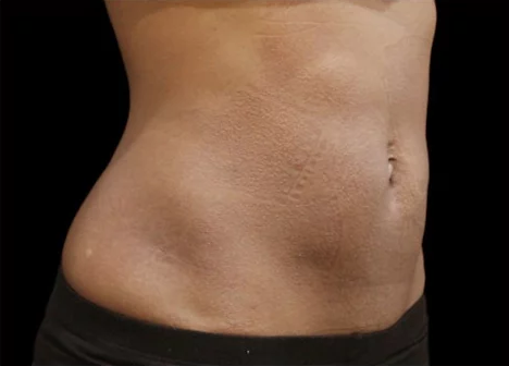 Vanquish Me Body Contouring - Vanquish ME is anti-aging solution uses a touchless, non-invasive Radio Frequency technology to heat up the adipose (fat) tissue. This causes fat cells death. Over time, your body eliminates the fat cells from the treated area via lymphatic system.
4 treatments are recommended spaced out 7-14 days apart. Vanquish Me Body Contouring - Vanquish ME is anti-aging solution uses a touchless, non-invasive Radio Frequency technology to heat up the adipose (fat) tissue. This causes fat cells death. Over time, your body eliminates the fat cells from the treated area via lymphatic system.
4 treatments are recommended spaced out 7-14 days apart.