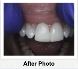 Repair chipped front teeth - These front teeth were chipped. We repaired them in one day with bonded composites. They look great! Repair chipped front teeth - These front teeth were chipped. We repaired them in one day with bonded composites. They look great!