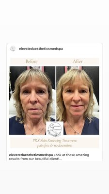 PRX Biostimulating Facial - PRX is an innovative treatment coming from Italy that stimulates collagen and elastin, smooths wrinkles and evens texture of your skin leaving you with the "PRX glow" Book a consultation to see if it is right for you PRX Biostimulating Facial - PRX is an innovative treatment coming from Italy that stimulates collagen and elastin, smooths wrinkles and evens texture of your skin leaving you with the "PRX glow" Book a consultation to see if it is right for you