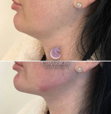 Kybella - KYBELLA® is the only FDA approved injectable treatment that destroys fat cells in the treatment area under the chin to improve your profile. Kybella® is a deoxycholic acid-based compound. Deoxycholic acid is a naturally-occurring molecule that aids in the breakdown and absorption of dietary fat. When injected into the fat beneath your skin, Kybella® causes the destruction of fat cells. This is a permanent treatment because once destroyed, those cells cannot store or accumulate fat. Many patients experience visible results in two treatments of 2 vials each, but up to four treatments may be needed depending on the area treated. Each treatment session may require up to 3 vials, depending on the area or how many areas are being treated. Treatment sessions should be spaced 6 – 12 weeks apart.