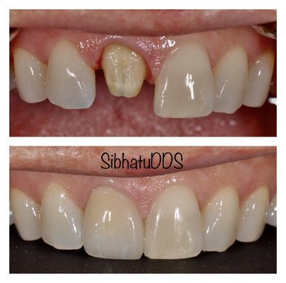 Cosmetic Cases - Both these patients had black discoloration and chipped crown on their front tooth. Dr. Sibhatu replaced the crowns with new all ceramic restorations. Both Patients were pleased with the results. Cosmetic Cases - Both these patients had black discoloration and chipped crown on their front tooth. Dr. Sibhatu replaced the crowns with new all ceramic restorations. Both Patients were pleased with the results.