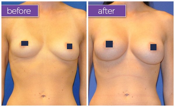Natural Fat Transfer: Breast Augmentation - Slimming down troublesome parts of your body is difficult, but making the right areas increase in size is impossible. Dieting and exercise can help you lose extra weight, but they won’t enhance the volume of your breasts, your buttocks, or other features that benefit from a plumper appearance. If you’re interested in filling out your figure, look into Belle Medical’s Fat Transfer procedure.
We’ve helped countless patients receive a natural body fat transfer without surgery or implants, delivering fantastic results in a safe and minimally invasive manner. Browse through our before and after picture gallery for an idea of what our Fat Transfer treatments can do for you. Natural Fat Transfer: Breast Augmentation - Slimming down troublesome parts of your body is difficult, but making the right areas increase in size is impossible. Dieting and exercise can help you lose extra weight, but they won’t enhance the volume of your breasts, your buttocks, or other features that benefit from a plumper appearance. If you’re interested in filling out your figure, look into Belle Medical’s Fat Transfer procedure.
We’ve helped countless patients receive a natural body fat transfer without surgery or implants, delivering fantastic results in a safe and minimally invasive manner. Browse through our before and after picture gallery for an idea of what our Fat Transfer treatments can do for you.