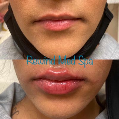 Derma Fillers - We use dermal fillers; smooth gel used to instantly smooth away wrinkles around your mouth, chin, and nose. It also is used to get fuller/plumper lips, ears, and cheeks. Acne scars and unevenness to the bridge of the nose can also be successfully treated with fillers. The gel consists of hyaluronic acid, a naturally hydrating substance that we lose as we age. Derma Fillers - We use dermal fillers; smooth gel used to instantly smooth away wrinkles around your mouth, chin, and nose. It also is used to get fuller/plumper lips, ears, and cheeks. Acne scars and unevenness to the bridge of the nose can also be successfully treated with fillers. The gel consists of hyaluronic acid, a naturally hydrating substance that we lose as we age.