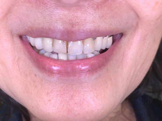 Dental Implants and Changing Older Restorations - This client had to lose some of her side teeth. She also didn't like how her older crowns looked when she smiled. Her bite was damaging her teeth over time and gave her TMJ pain. So I took out the badly damaged teeth and placed immediate dental implants, and gave her a new smile makeover. During this process I changed her bite significantly and when we completed her case, her implants were strong, she loved her new smile, and her TMJ no longer gave her pain! I love cases where we can address teeth problems, cosmetic issues, and TMJ pain all into one treatment. Dental Implants and Changing Older Restorations - This client had to lose some of her side teeth. She also didn't like how her older crowns looked when she smiled. Her bite was damaging her teeth over time and gave her TMJ pain. So I took out the badly damaged teeth and placed immediate dental implants, and gave her a new smile makeover. During this process I changed her bite significantly and when we completed her case, her implants were strong, she loved her new smile, and her TMJ no longer gave her pain! I love cases where we can address teeth problems, cosmetic issues, and TMJ pain all into one treatment.