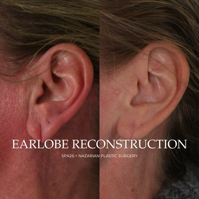 Earlobe Reconstruction: Before & After - Earlobe Reconstruction is a cosmetic surgical procedure to restore the structural integrity and appearance of torn or stretched earlobes. It is a popular corrective treatment for people experiencing abnormal earlobe structure due to ear tearing, trauma, piercings, or insertion of ear gauges.

This reconstructive surgery can enhance facial structure, shape, and appearance with a 40-minute procedure using a small incision. Assume you are unhappy with the appearance of your earlobes or have struggles wearing your favorite earrings. Earlobe Reconstructive Surgery may be the right approach in that case.

Plastic surgeon near me
Earlobe Reconstruction (Reduction) in LA
Earlobe Reconstruction (Reduction) in Beverly Hills
Plastic surgeons that offer financing
Women Plastic Surgeon
Plastic Surgeon in Beverly Hills
Netflix Surgeon
Women Owned