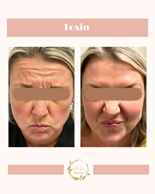 Results you can feel confident in! - At BMA Medspa, we believe the best aesthetic results are the ones that still look like you.
This collection of before and after images represents real patients and real outcomes, all achieved through thoughtful, customized care. No two faces, skin types, or goals are the same, and that is exactly how we approach every treatment. Our focus is never on following trends or creating dramatic change. Instead, we prioritize balance, subtle enhancement, and results that feel natural and confident.
Every patient you see here began with a consultation. That conversation is where we listen closely, evaluate individual needs, and create a personalized plan based on facial structure, skin health, lifestyle, and long-term goals. Treatments are selected intentionally and adjusted over time, because aesthetic care is not a single appointment, but a process.
You may notice that the results throughout this gallery look different from one another. That is by design. Some patients are focused on softening expression lines, others on improving skin texture, restoring volume, or maintaining a refreshed appearance over time. There is no one-size-fits-all outcome at BMA Medspa, and there is no “standard look” we try to create.
Our goal is for patients to leave feeling like themselves, just more refreshed, more confident, and more comfortable in their own skin. The most meaningful feedback we hear is when someone says they look well-rested, healthy, or like they have been taking great care of themselves, without anyone being able to pinpoint exactly why.
As a Nurse Practitioner-supervised medical aesthetics clinic, patient safety and education are always at the center of what we do. Treatments are conservative, carefully planned, and tailored to each individual. We take the time to explain options, set realistic expectations, and recommend only what makes sense for the person in front of us.
If you are exploring aesthetic treatments for the first time, or if you are looking for a provider who values natural-looking results and personalized care, we hope these images help you feel more at ease. They are meant to reflect what is possible when experience, intention, and customization come together.
When you choose BMA Medspa, you are choosing a team that values your comfort, your confidence, and your individuality. Our commitment is not just to how you look when you leave, but to how you feel about your experience and your results long after.
We look forward to helping you create results you can feel confident in. Results you can feel confident in! - At BMA Medspa, we believe the best aesthetic results are the ones that still look like you.
This collection of before and after images represents real patients and real outcomes, all achieved through thoughtful, customized care. No two faces, skin types, or goals are the same, and that is exactly how we approach every treatment. Our focus is never on following trends or creating dramatic change. Instead, we prioritize balance, subtle enhancement, and results that feel natural and confident.
Every patient you see here began with a consultation. That conversation is where we listen closely, evaluate individual needs, and create a personalized plan based on facial structure, skin health, lifestyle, and long-term goals. Treatments are selected intentionally and adjusted over time, because aesthetic care is not a single appointment, but a process.
You may notice that the results throughout this gallery look different from one another. That is by design. Some patients are focused on softening expression lines, others on improving skin texture, restoring volume, or maintaining a refreshed appearance over time. There is no one-size-fits-all outcome at BMA Medspa, and there is no “standard look” we try to create.
Our goal is for patients to leave feeling like themselves, just more refreshed, more confident, and more comfortable in their own skin. The most meaningful feedback we hear is when someone says they look well-rested, healthy, or like they have been taking great care of themselves, without anyone being able to pinpoint exactly why.
As a Nurse Practitioner-supervised medical aesthetics clinic, patient safety and education are always at the center of what we do. Treatments are conservative, carefully planned, and tailored to each individual. We take the time to explain options, set realistic expectations, and recommend only what makes sense for the person in front of us.
If you are exploring aesthetic treatments for the first time, or if you are looking for a provider who values natural-looking results and personalized care, we hope these images help you feel more at ease. They are meant to reflect what is possible when experience, intention, and customization come together.
When you choose BMA Medspa, you are choosing a team that values your comfort, your confidence, and your individuality. Our commitment is not just to how you look when you leave, but to how you feel about your experience and your results long after.
We look forward to helping you create results you can feel confident in.