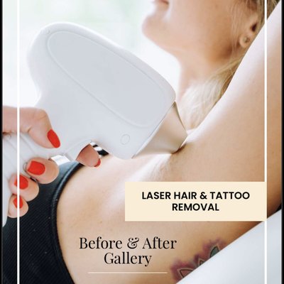 Laser Hair and Tattoo Removal - Laser hair removal is a medical procedure that uses a concentrated beam of light (laser) to remove unwanted hair. During laser hair removal, a laser emits a light that is absorbed by the pigment (melanin) in the hair.
Lasers heat up the ink particles in your skin to break them down into smaller particles, which are easier for your immune system to remove. It can take multiple laser therapy sessions to remove a tattoo. Laser Hair and Tattoo Removal - Laser hair removal is a medical procedure that uses a concentrated beam of light (laser) to remove unwanted hair. During laser hair removal, a laser emits a light that is absorbed by the pigment (melanin) in the hair.
Lasers heat up the ink particles in your skin to break them down into smaller particles, which are easier for your immune system to remove. It can take multiple laser therapy sessions to remove a tattoo.