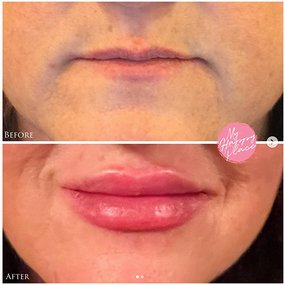 Nobody Is Going To Believe These Lips Belong To The Same Person! - Nobody is going to believe these lips belong to the same person!
This took about 4 sessions over 2 years to achieve these gorgeous results. The after picture is immediately after without anything on her lips...no gloss...no lipstick...just lips. Notice how much younger her mouth looks after. Come see me and treat yourself today. Nobody Is Going To Believe These Lips Belong To The Same Person! - Nobody is going to believe these lips belong to the same person!
This took about 4 sessions over 2 years to achieve these gorgeous results. The after picture is immediately after without anything on her lips...no gloss...no lipstick...just lips. Notice how much younger her mouth looks after. Come see me and treat yourself today.