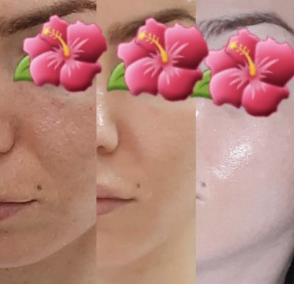 Microneedling Skin Renewal - Professional microneedling procedure focused on supporting skin regeneration and improving overall texture. The treatment works by stimulating the skin’s natural repair response and collagen production. Temporary redness after the session is a normal and expected reaction. Microneedling Skin Renewal - Professional microneedling procedure focused on supporting skin regeneration and improving overall texture. The treatment works by stimulating the skin’s natural repair response and collagen production. Temporary redness after the session is a normal and expected reaction.