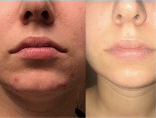 Acne Solution Treatment Facial - Developed specifically for deep-pore cleansing and illuminating the bacteria on the skin that cause acne.
acne control serum are applied to solve your acne problem. Acne Solution Treatment Facial - Developed specifically for deep-pore cleansing and illuminating the bacteria on the skin that cause acne.
acne control serum are applied to solve your acne problem.