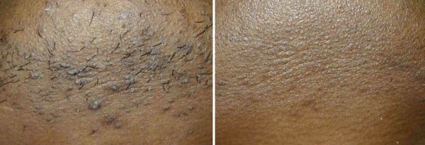 Laser hair removal for all skin types - We have been in this business and same location about 20years. We use Cutera’s product with long wavelength Nd:YAG , effective and safe for all skin types.