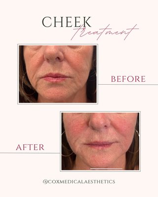 Cheek filler - Cheek fillers are a cosmetic treatment used to restore volume in the cheeks, which can diminish due to aging. The filler is composed of hyaluronic acid, a substance naturally found in the body, can provide immediate improvement in facial fullness and contours.