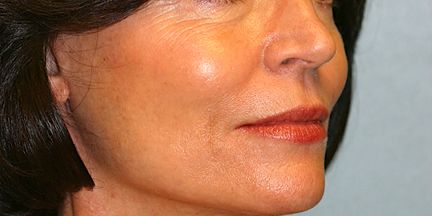 Cheek & Chin Implants - With extensive experience in all Oral and Maxillo-Facial surgical procedures, Dr. Gilbert has been teaching other doctors for the past 20 years. Advanced training and a particular interest in the reconstruction of Oral and Facial deformities have fueled Dr. Gilbert’s passion for dental implant replacement of teeth, jaw reconstruction and orthognathic surgery, facial cosmetic, and reconstructive surgery.