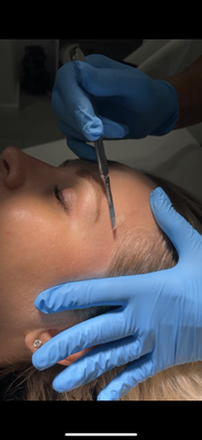 Microdermabrasion - Microdermabrasion is a minimally invasive procedure used to renew overall skin tone and texture. It can improve the appearance of sun damage, wrinkles, fine lines, age spots, acne scarring, melasma, and other skin-related concerns and conditions. Microdermabrasion - Microdermabrasion is a minimally invasive procedure used to renew overall skin tone and texture. It can improve the appearance of sun damage, wrinkles, fine lines, age spots, acne scarring, melasma, and other skin-related concerns and conditions.