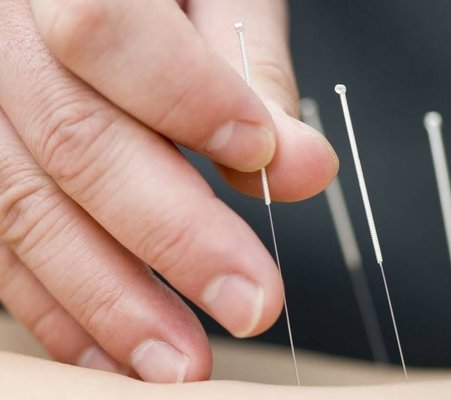 Acupuncture - Acupuncture is used mainly to relieve discomfort associated with a variety of diseases and conditions, including:
Chemotherapy-induced and postoperative nausea and vomiting.
Dental pain.
Fibromyalgia.
Headaches, including tension headaches and migraines.
Labor pain.
Lower back pain.
Neck pain.
Osteoarthritis. Acupuncture - Acupuncture is used mainly to relieve discomfort associated with a variety of diseases and conditions, including:
Chemotherapy-induced and postoperative nausea and vomiting.
Dental pain.
Fibromyalgia.
Headaches, including tension headaches and migraines.
Labor pain.
Lower back pain.
Neck pain.
Osteoarthritis.