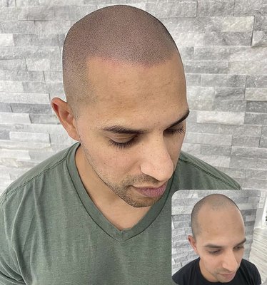 New portfolio - The magic of scalp Micropigmentation