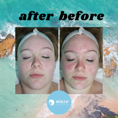 Facials - acne prone, redness - Both of our clients have issues with redness from sun damage and/or acne. Using our Eminence line, free of parabens, chemicals and harsh ingredients, we were able to brighten and soften our client's skin after just one facial.
Dermaplaning removes excess fine hairs which are known for trapping the dirt, oil and dead skin cells in your pores that are the main cause of acne and blemishes. It leaves your skin brighter, and healthier giving you that “baby smooth” look and feel!
A facial is a spa therapy and massage that leaves your skin cleaner, softer, younger, and truly transformed. Facials can help clear clogged pores, quench parched skin and remove dead cells. Facials involve some massage which aids in blood circulation and lymphatic drainage. Facials - acne prone, redness - Both of our clients have issues with redness from sun damage and/or acne. Using our Eminence line, free of parabens, chemicals and harsh ingredients, we were able to brighten and soften our client's skin after just one facial.
Dermaplaning removes excess fine hairs which are known for trapping the dirt, oil and dead skin cells in your pores that are the main cause of acne and blemishes. It leaves your skin brighter, and healthier giving you that “baby smooth” look and feel!
A facial is a spa therapy and massage that leaves your skin cleaner, softer, younger, and truly transformed. Facials can help clear clogged pores, quench parched skin and remove dead cells. Facials involve some massage which aids in blood circulation and lymphatic drainage.