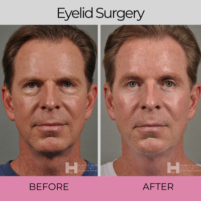 Eye Lift - Restore A Youthful & Self-Assured Appearance!
Our goal is to create a discreet, caring environment where you feel safe to honestly express your wishes and receive highly personalized options that will achieve your aesthetic goals. With over 25 years of experience, Dr. Hall’s approach to patients is to treat each one as an individual and commit the time and effort to do what is best for them.