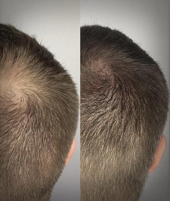 Scalp Micropigmentation - More on Instagram @belris.art