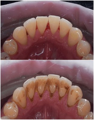 Deep Cleaning & Gum Health - Discover the transformative results of our professional dental deep cleaning services! Our expert team removes plaque, tartar, and bacteria, promoting healthier gums and a brighter, fresher smile. With scaling and root planing, we prevent gum disease and ensure long-lasting oral health. Experience the benefits of a thorough clean, gum health, and a radiant smile today! Teeth cleaning, gum disease prevention, and oral hygiene at its best. Deep Cleaning & Gum Health - Discover the transformative results of our professional dental deep cleaning services! Our expert team removes plaque, tartar, and bacteria, promoting healthier gums and a brighter, fresher smile. With scaling and root planing, we prevent gum disease and ensure long-lasting oral health. Experience the benefits of a thorough clean, gum health, and a radiant smile today! Teeth cleaning, gum disease prevention, and oral hygiene at its best.