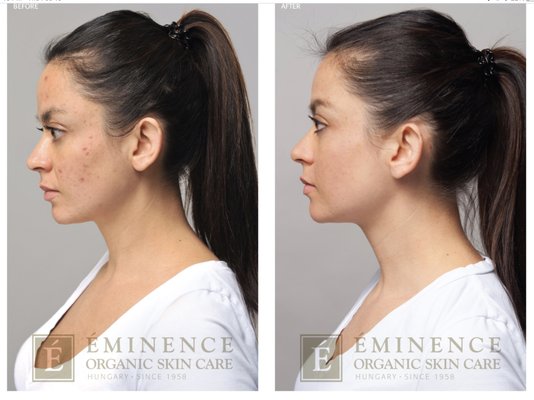 Mild acne treatments before and after. - 🍓Get visible results. 🌿 Monthly acne facials are recommended 🫐 Free product consultation 🍓 Mild acne treatments before and after. - 🍓Get visible results. 🌿 Monthly acne facials are recommended 🫐 Free product consultation 🍓