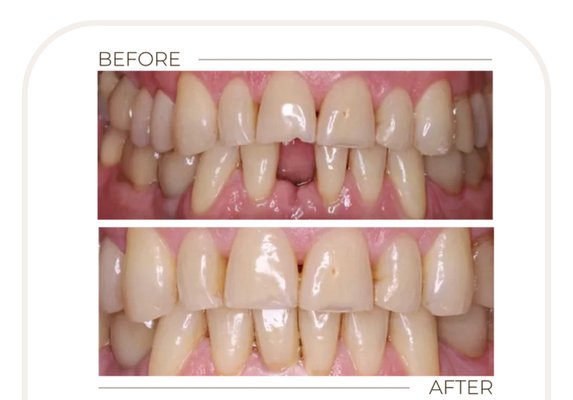 Dental Implant - Transform your smile with our advanced dental implants, designed to provide a durable, natural-looking solution for missing teeth.