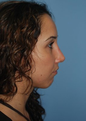 Rhinoplasty - Nose reshaping, medically known as rhinoplasty, can make a significant difference in the balance of the facial features and help patients who feel self-conscious about the shape of their nose. By performing rhinoplasty in San Francisco, Dr. Kenneth Bermudez can decrease or increase the size of the nose, reduce the bridge or tip of the nose, and even change the shape of the nostrils. Rhinoplasty is a special focus of Dr. Kenneth Bermudez, and he boasts a large number of nose surgery patients who are extremely satisfied with their results. If you would like to learn how rhinoplasty can help you achieve your aesthetic dreams, please read on. Rhinoplasty - Nose reshaping, medically known as rhinoplasty, can make a significant difference in the balance of the facial features and help patients who feel self-conscious about the shape of their nose. By performing rhinoplasty in San Francisco, Dr. Kenneth Bermudez can decrease or increase the size of the nose, reduce the bridge or tip of the nose, and even change the shape of the nostrils. Rhinoplasty is a special focus of Dr. Kenneth Bermudez, and he boasts a large number of nose surgery patients who are extremely satisfied with their results. If you would like to learn how rhinoplasty can help you achieve your aesthetic dreams, please read on.