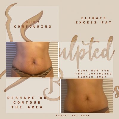 1hour ultrasonic cavitation and radio frequency. - Result may vary! Picture shown is 3 days after detoxification. It’s important to follow after care directions for best results. 1hour ultrasonic cavitation and radio frequency. - Result may vary! Picture shown is 3 days after detoxification. It’s important to follow after care directions for best results.