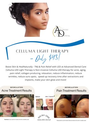 Advanced Dental Care LED Light Therapy - Try Celluma Light Therapy - Boost Skin & Heal
Naturally - TMJ & Pain Relief with LED at Advanced Dental Care in Rialto!
Non-invasive Celluma LED therapy for acne, aging, pain relief, collagen producing, relaxation, reduce inflammation, and speed up recovery time after extractions and implants. Advanced Dental Care LED Light Therapy - Try Celluma Light Therapy - Boost Skin & Heal
Naturally - TMJ & Pain Relief with LED at Advanced Dental Care in Rialto!
Non-invasive Celluma LED therapy for acne, aging, pain relief, collagen producing, relaxation, reduce inflammation, and speed up recovery time after extractions and implants.