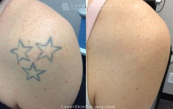 Tattoo Removal Before & Afters - Laser treatments can remove unwanted tattoos without surgery or extensive downtime. At Laser & Skin Surgery Center of Pennsylvania, our board-certified dermatologists use the most advanced laser devices to eliminate any shade of body ink.
A tattoo you once loved doesn’t always hold the same shine as you age. If you’re no longer happy with your tattoo, laser tattoo removal is a safe and effective treatment to permanently get rid of unwanted ink. After a series of quick, comfortable treatments, your tattoo will fade, leaving behind clear skin. Tattoo Removal Before & Afters - Laser treatments can remove unwanted tattoos without surgery or extensive downtime. At Laser & Skin Surgery Center of Pennsylvania, our board-certified dermatologists use the most advanced laser devices to eliminate any shade of body ink.
A tattoo you once loved doesn’t always hold the same shine as you age. If you’re no longer happy with your tattoo, laser tattoo removal is a safe and effective treatment to permanently get rid of unwanted ink. After a series of quick, comfortable treatments, your tattoo will fade, leaving behind clear skin.
