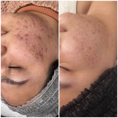 Chemical Peels - 310-946-9318 - Check out our chemical peels options to drastically improve the appearance of your skin.