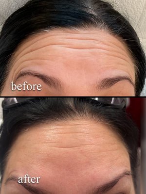 Before & After - Explore out before and after gallery to see real results from our clients! From skin rejuvenation to facial countouring, our treatments are designed to enchance natural beauty and restore confidence. Before & After - Explore out before and after gallery to see real results from our clients! From skin rejuvenation to facial countouring, our treatments are designed to enchance natural beauty and restore confidence.