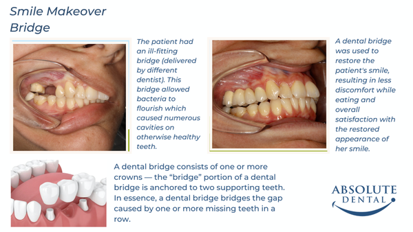 Bridge - The patient had an ill-fitting bridge (delivered by different dentist). This bridge allowed bacteria to flourish which caused numerous cavities on otherwise healthy teeth.
A dental bridge was used to restore the patient's smile, resulting in less discomfort while eating and overall satisfaction with the restored appearance of her smile. Bridge - The patient had an ill-fitting bridge (delivered by different dentist). This bridge allowed bacteria to flourish which caused numerous cavities on otherwise healthy teeth.
A dental bridge was used to restore the patient's smile, resulting in less discomfort while eating and overall satisfaction with the restored appearance of her smile.