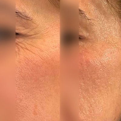 Morpheus8 for Face - Experience the power of #Morpheus8! This non-surgical treatment is perfect for those looking to reduce wrinkles and fine lines, and to restore their youthful look.
Book your appointment with Dr. Doris
(310) 272-9988 Morpheus8 for Face - Experience the power of #Morpheus8! This non-surgical treatment is perfect for those looking to reduce wrinkles and fine lines, and to restore their youthful look.
Book your appointment with Dr. Doris
(310) 272-9988