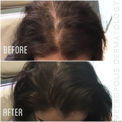 Hair Loss - Keralase - Hair loss treatments can varied. We love PRP and Keralase MD for best results. Hair Loss - Keralase - Hair loss treatments can varied. We love PRP and Keralase MD for best results.