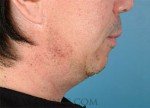 Chin Implant - Chin Implant before and after Chin Implant - Chin Implant before and after