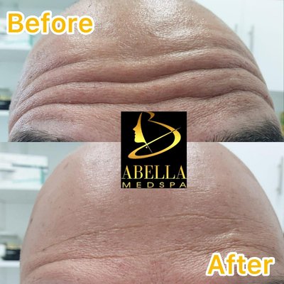 Botox treatment before and after for men and women - Botox injection is a treatment that has been used in esthetics to smooth expressions marks in various areas of the face.