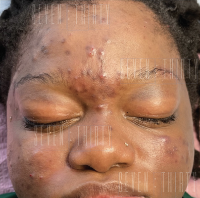 Inflamed dehydrated skin - This client came to us with dehydrated acne-prone skin. First, we addressed her dehydrated skin with a trio of gentle non-pore clogging products for sensitive skin. Next, we slowly added our acne-fighting products that neutralize bacteria, reduce inflammation, and lightened her hyperpigmentation.