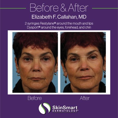Dr. Callahan's Before and After Photos - This is a small showcase of cosmetic procedures performed by our founder and medical director, Dr. Elizabeth F. Callahan. Visit our website to learn more about our practice! Dr. Callahan's Before and After Photos - This is a small showcase of cosmetic procedures performed by our founder and medical director, Dr. Elizabeth F. Callahan. Visit our website to learn more about our practice!