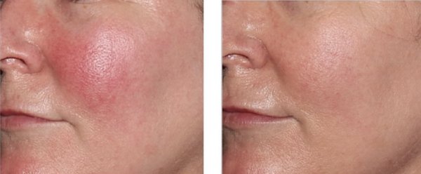 Halo & BBL Laser Treatment - HALO and BBL are laser treatments that rejuvenate the skin. HALO targets both surface and deeper layers to improve texture and reduce wrinkles, while BBL uses light to treat pigmentation, redness, and acne, stimulating collagen for smoother skin. Both have minimal downtime and enhance skin appearance.