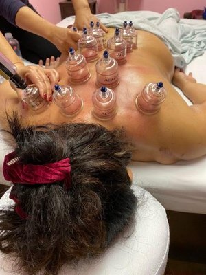 Cupping pain relief massage in training - We will both leave the cups in place, or slide them around using lotion or oil.The pressure that the cups create draws blood to the affected area, increasing your blood flow overall, that increased blood flow can relieve muscle tension, improve circulation, and reduce inflammation.
What's cupping even use d for?Generally, cupping is used to treat chronic pain—back pain and headaches.It’s all about getting rid of musculoskeletal pain, which is often a physical manifestation of chronic stress which is what cupping helps reduce Chronic Pain.
Cupping can also help with detoxification ,and relieving inflammation in the area. Cupping pain relief massage in training - We will both leave the cups in place, or slide them around using lotion or oil.The pressure that the cups create draws blood to the affected area, increasing your blood flow overall, that increased blood flow can relieve muscle tension, improve circulation, and reduce inflammation.
What's cupping even use d for?Generally, cupping is used to treat chronic pain—back pain and headaches.It’s all about getting rid of musculoskeletal pain, which is often a physical manifestation of chronic stress which is what cupping helps reduce Chronic Pain.
Cupping can also help with detoxification ,and relieving inflammation in the area.