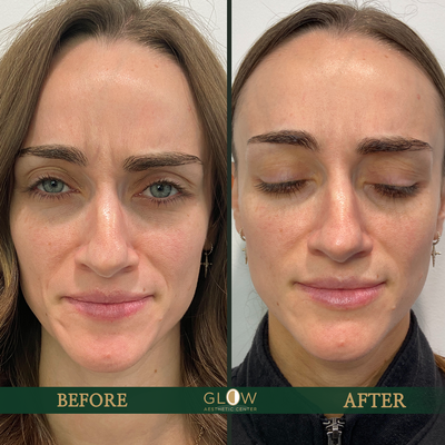 Wrinkle Reduction - At Glow Aesthetic Center, one of our treatment specialties is wrinkle reduction for our patients. There are a number of treatments one can choose from to deal with moderate to severe wrinkles, including neurotoxin and hyaluronic acid dermal fillers. We hold a number of different products that our patients choose from for there wrinkle/cosmetic needs including Juvederm Ultra Plus XC, Juvederm Volluma, Juvederm Vollure, Juvederm Vollbella, Restalyne Lyft, Restalyne Refyne, Botox, Dysport, Xeomin, Jeuvea, and much more! Wrinkle Reduction - At Glow Aesthetic Center, one of our treatment specialties is wrinkle reduction for our patients. There are a number of treatments one can choose from to deal with moderate to severe wrinkles, including neurotoxin and hyaluronic acid dermal fillers. We hold a number of different products that our patients choose from for there wrinkle/cosmetic needs including Juvederm Ultra Plus XC, Juvederm Volluma, Juvederm Vollure, Juvederm Vollbella, Restalyne Lyft, Restalyne Refyne, Botox, Dysport, Xeomin, Jeuvea, and much more!