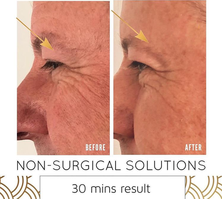 Non Surgical Solutions - Below are a couple Frequently Asked Questions (FAQ). For more info call or visit us online. Don't forget to inquire about our 45% DISCOUNT!
--------------
(FAQ): How Long Will This Last?
(Answer): Results with these sessions are long-lasting and the fat loss achieved during slimming sessions is permanent and the effect of the toning lasts for a long time although many clients choose to come in for a touch up every few months... Keep in mind, the fat cells that are eliminated during our sessions are gone forever, but clients may still gain fat back in the treated area by refilling the remaining fat cells if they do not maintain a balanced lifestyle...
------------------
(FAQ): Does it hurt?
(Answer): All slimming sessions and toning sessions are cold, refreshing and after the initial shock of the cold, most clients report that they enjoy and look forward to the feeling of the treatment.... Non Surgical Solutions - Below are a couple Frequently Asked Questions (FAQ). For more info call or visit us online. Don't forget to inquire about our 45% DISCOUNT!
--------------
(FAQ): How Long Will This Last?
(Answer): Results with these sessions are long-lasting and the fat loss achieved during slimming sessions is permanent and the effect of the toning lasts for a long time although many clients choose to come in for a touch up every few months... Keep in mind, the fat cells that are eliminated during our sessions are gone forever, but clients may still gain fat back in the treated area by refilling the remaining fat cells if they do not maintain a balanced lifestyle...
------------------
(FAQ): Does it hurt?
(Answer): All slimming sessions and toning sessions are cold, refreshing and after the initial shock of the cold, most clients report that they enjoy and look forward to the feeling of the treatment....