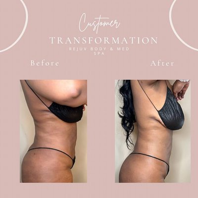 Post Operative Results - The world of health and beauty is always changing and evolving. As a result, new products and amazing services are finding their way to your door every single day. One of the biggest innovations in the beauty health and wellness world is that of body contouring. This non-invasive cosmetic procedure can be performed from the comfort of our beauty spa. If you have never been introduced to the benefits of body contouring, enjoy this short primer before booking your first session! Post Operative Results - The world of health and beauty is always changing and evolving. As a result, new products and amazing services are finding their way to your door every single day. One of the biggest innovations in the beauty health and wellness world is that of body contouring. This non-invasive cosmetic procedure can be performed from the comfort of our beauty spa. If you have never been introduced to the benefits of body contouring, enjoy this short primer before booking your first session!